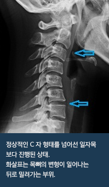 vertebra_03